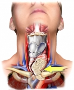 imagine cu cancerul tiroidian